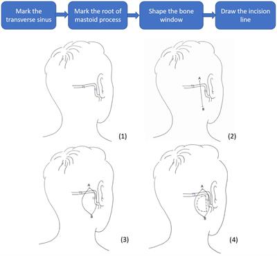 Surgical anatomy of sigmoid sinus with evaluation of its venous dominance for advances in preoperative planning